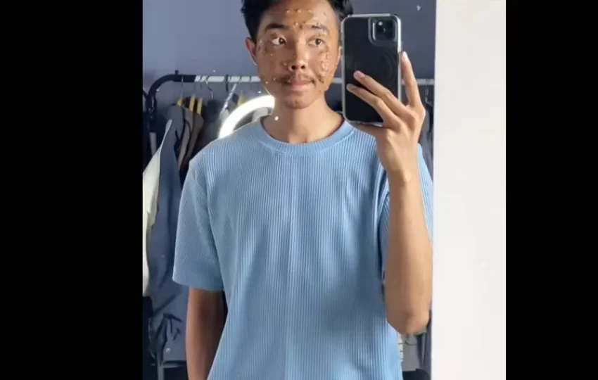  Homem contrai infecção viral após usar roupa de brechó sem lavar