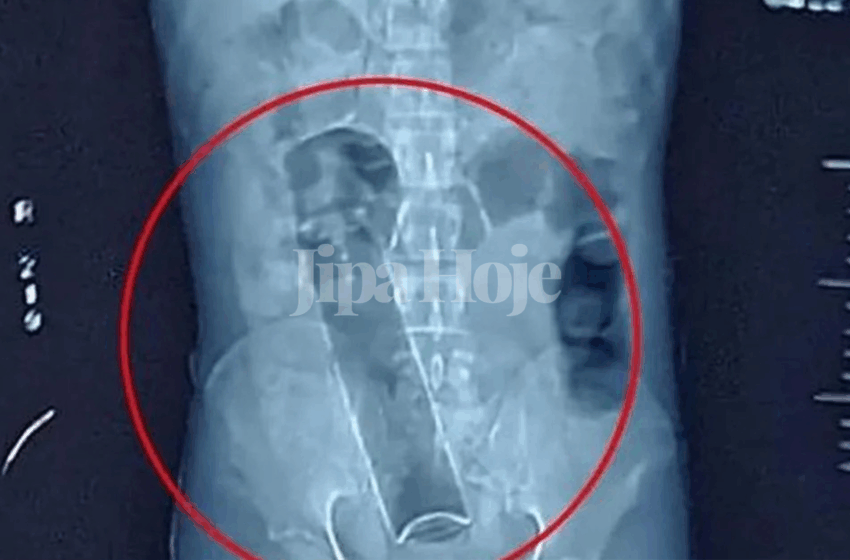  Empresário Para No Hospital Após Introduzir Desodorante No Ânus Em Ji-Paraná